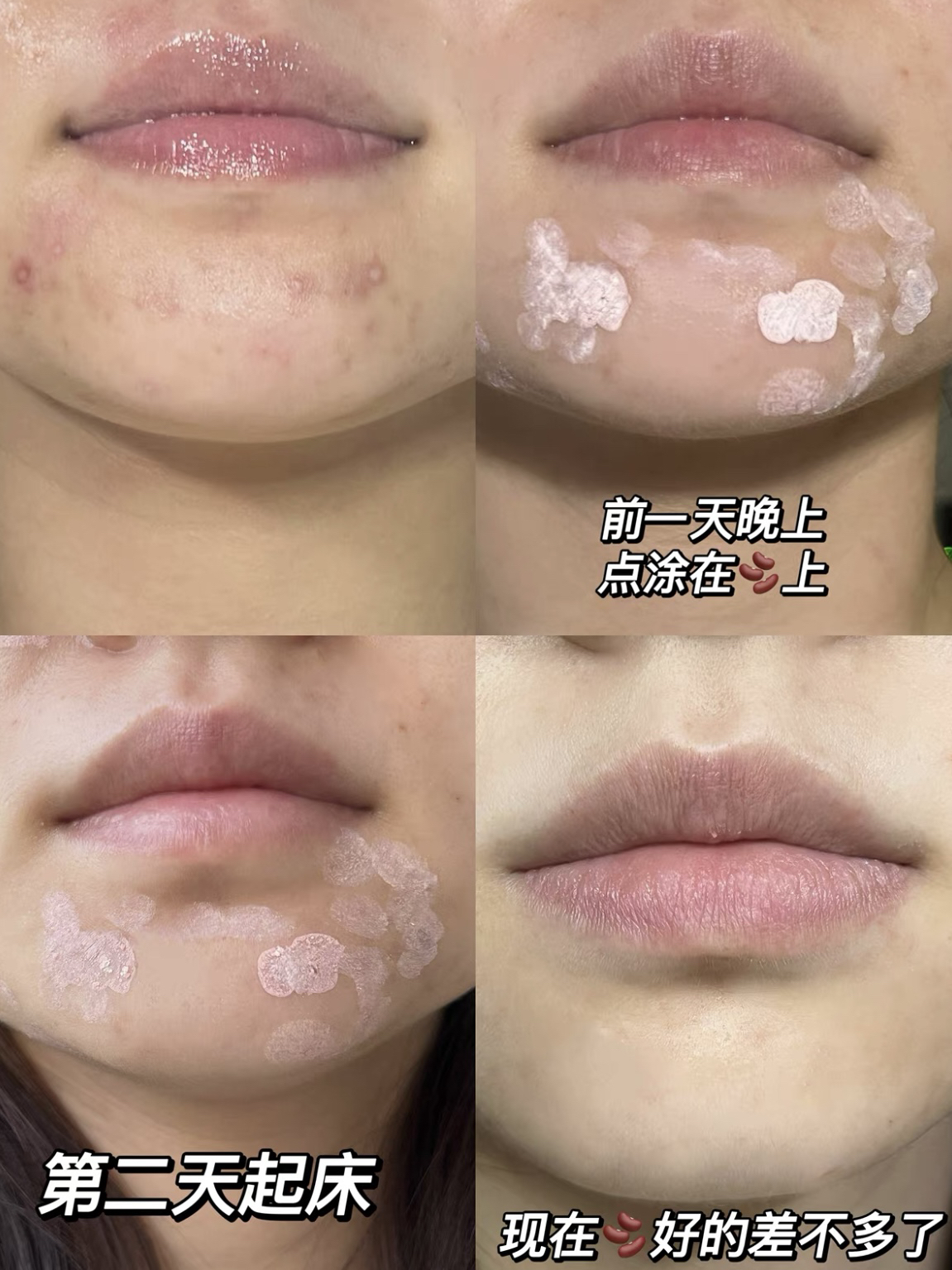 123！跟痘痘“甜美粉嫩”Say Goodbey👋