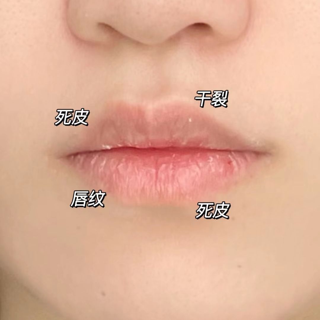 万年不愈的唇炎竟然好了