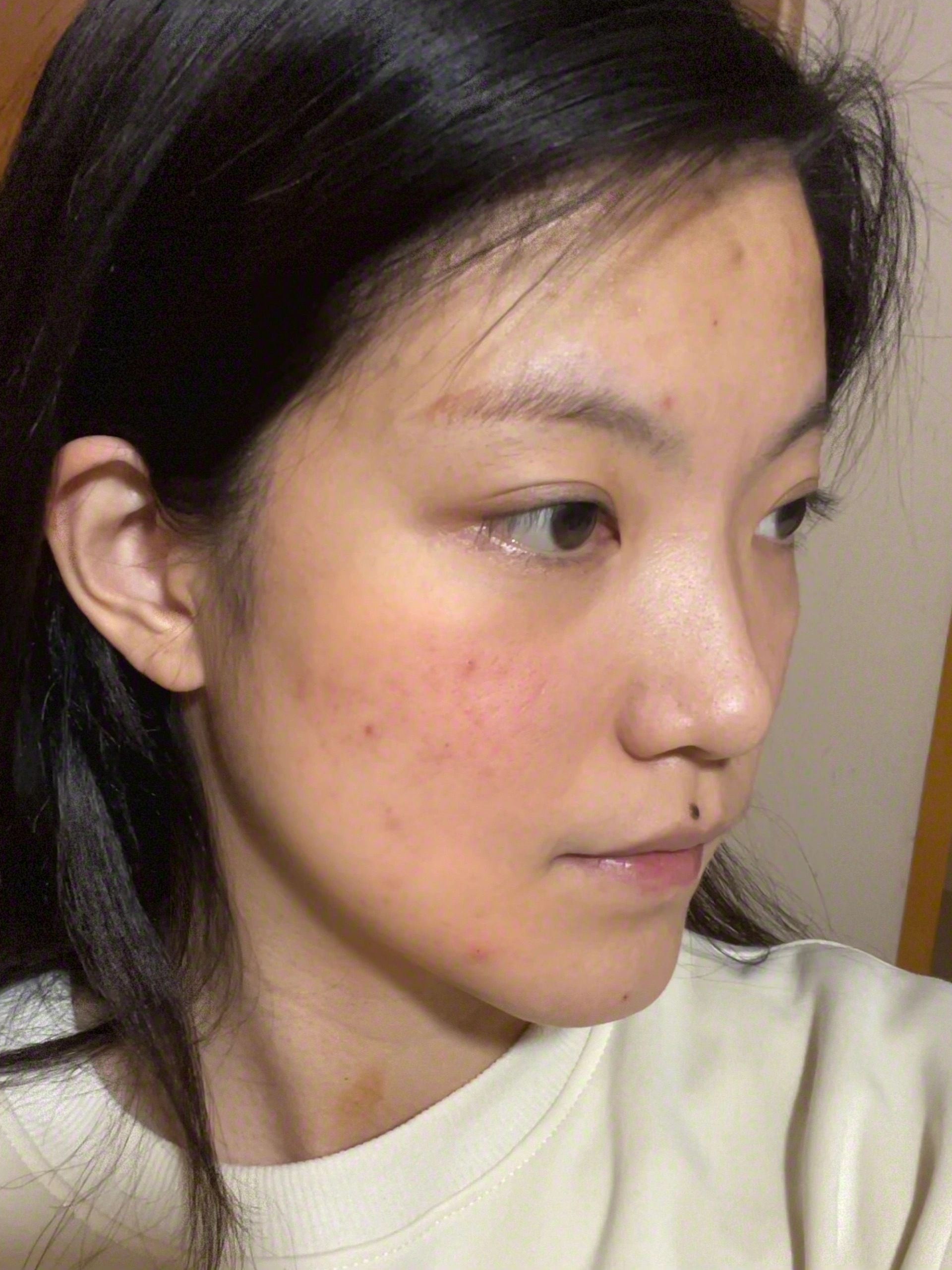 长痘的是真的烦啊....