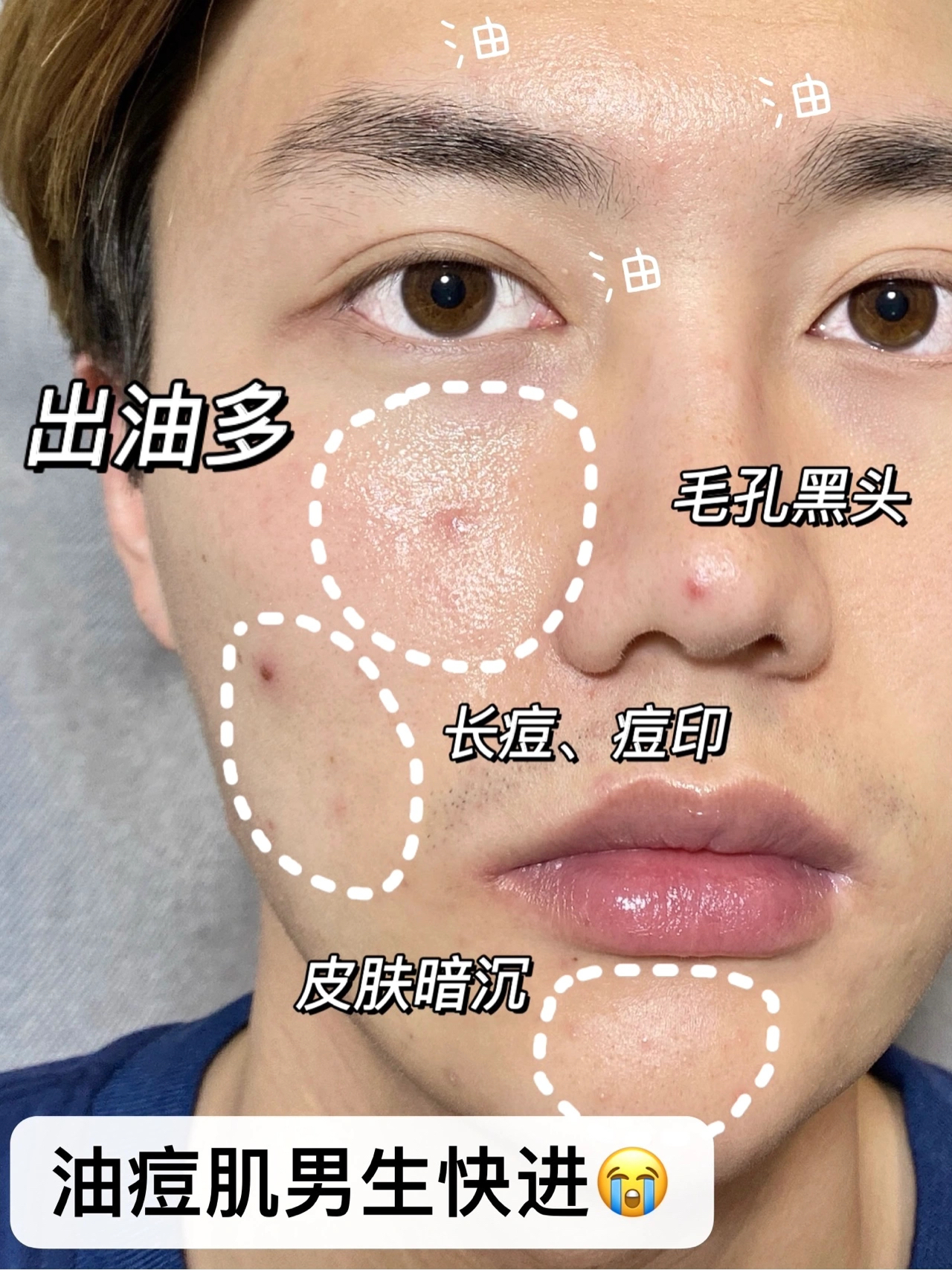 求大数据把我推给所有油痘肌男生！拒绝油腻！