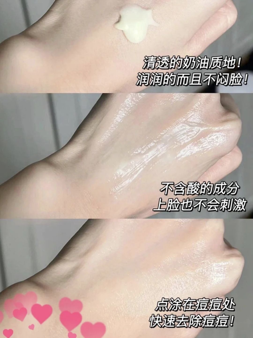 痘痘肌全抹没🌈一瓶搞定痘痘黑头闭口粉刺