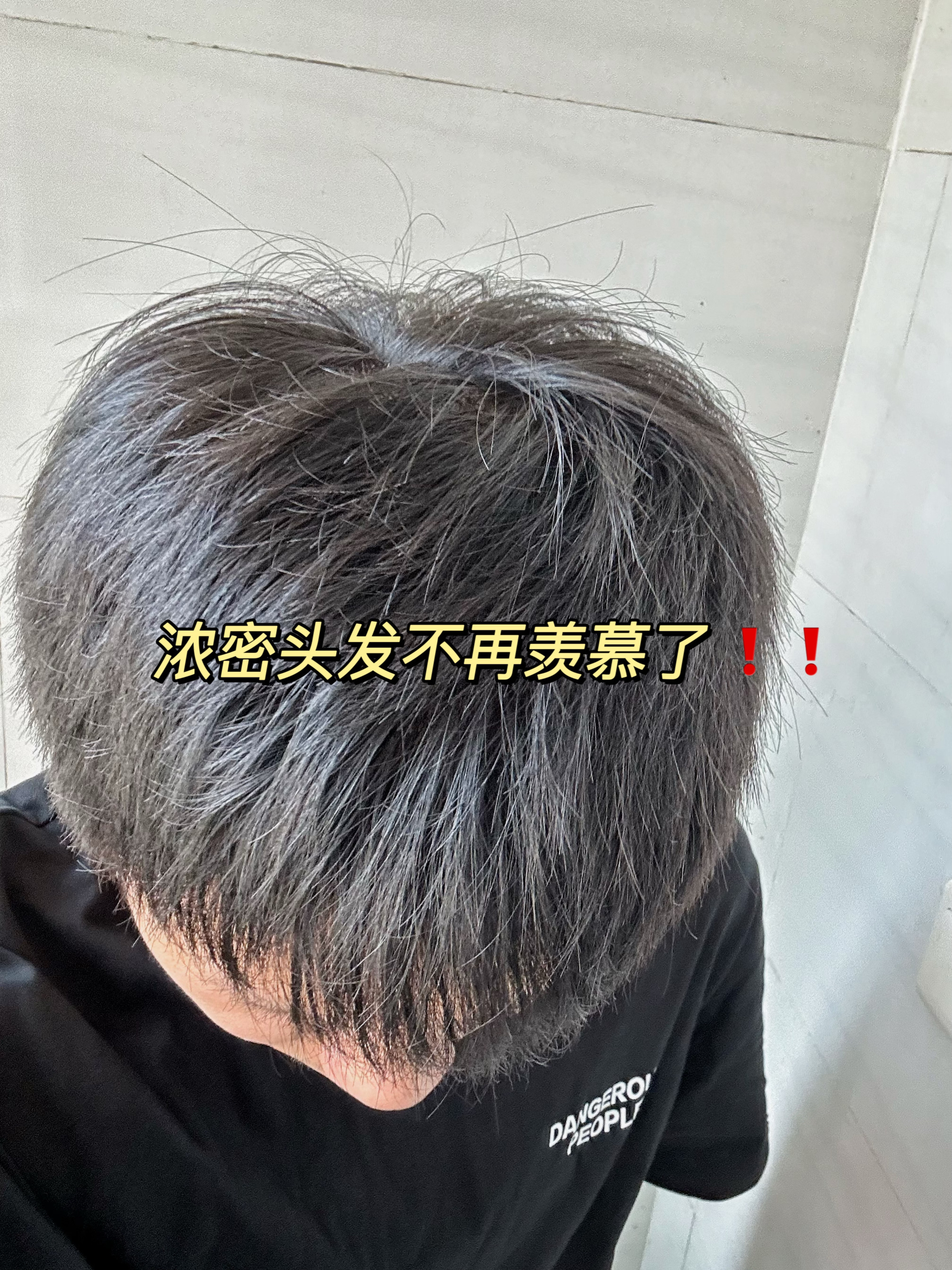 浓密头发我也拥有了！