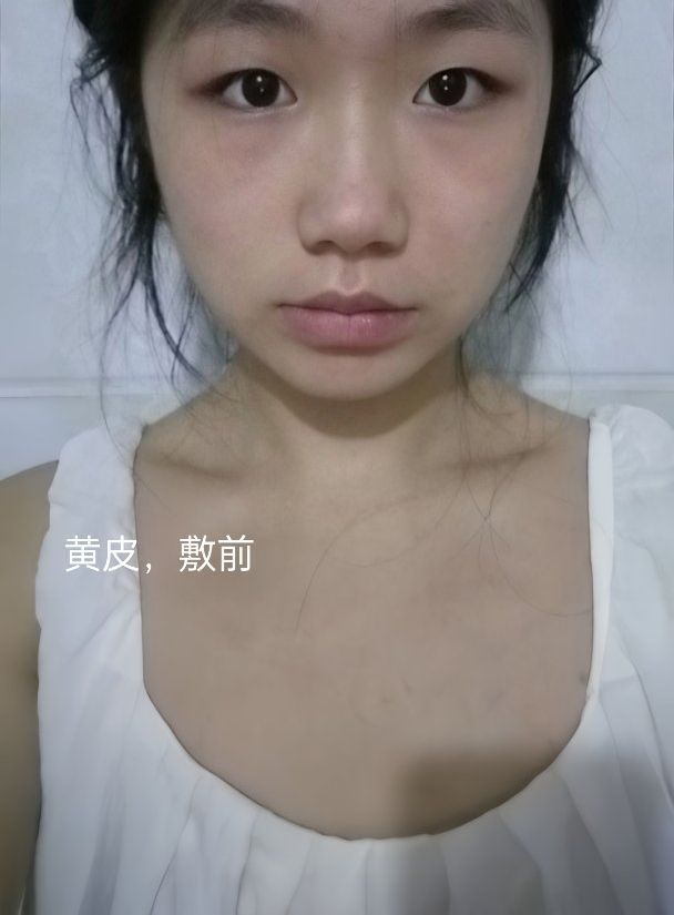RNW小银管真实测