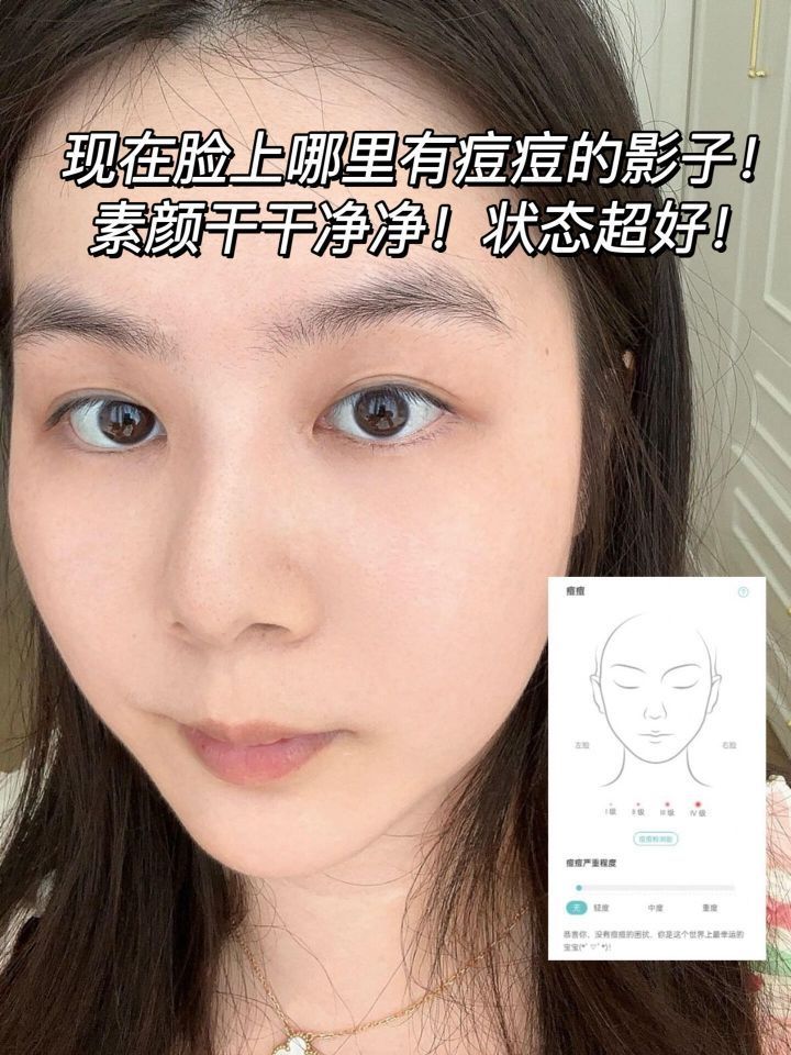 和痘肌和解了!这个夏天我强到可怕!