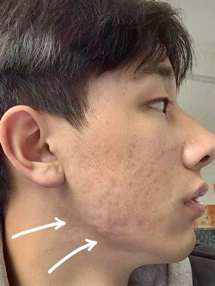 这张脸要是没痘！不敢想象得有多少人追