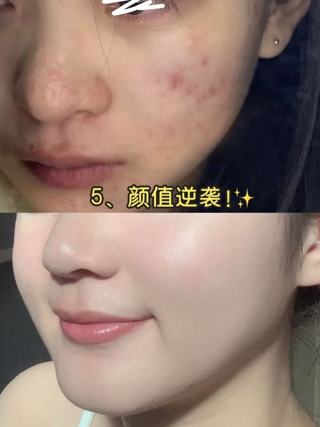 成功上岸，痘痘老家都被掀翻了！🤗