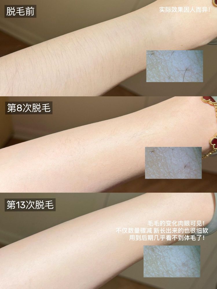 多毛星人！脱毛仪届天花板使用心得（人间泥鳅版！