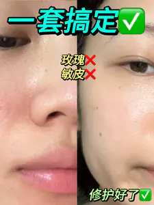 还有哪个玫瑰敏皮没有用过传明酸啊