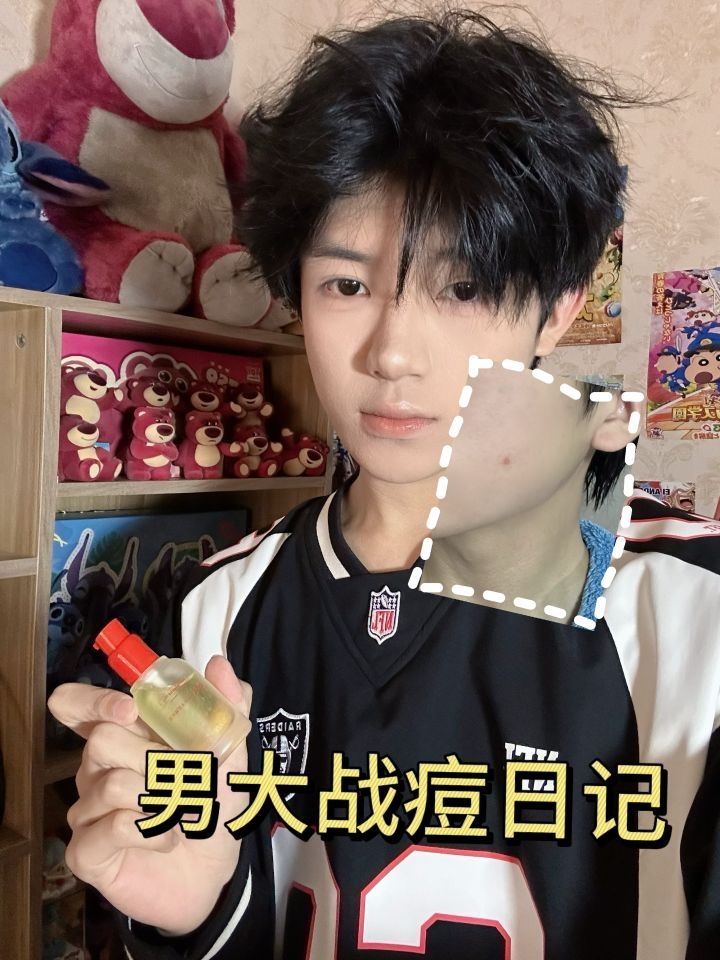男大祛痘看这里，亲测有效 
