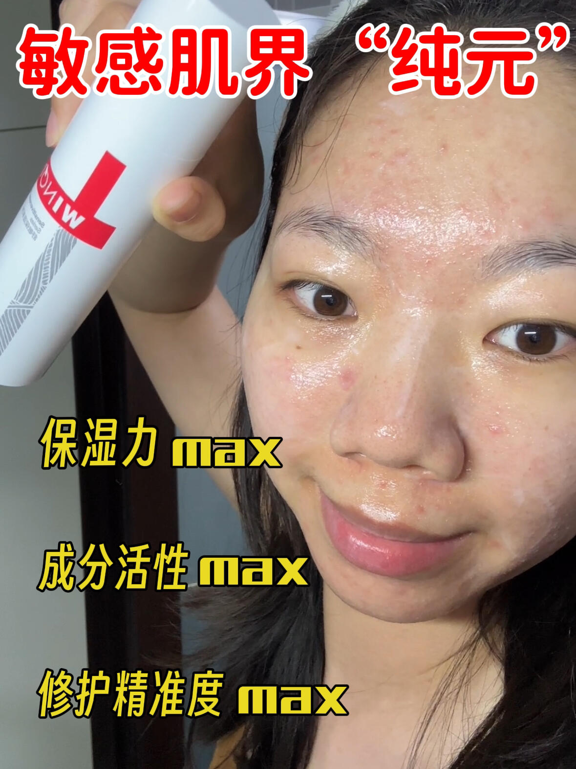 痘敏皮实测｜薇诺娜二代这次追着敏皮精修护