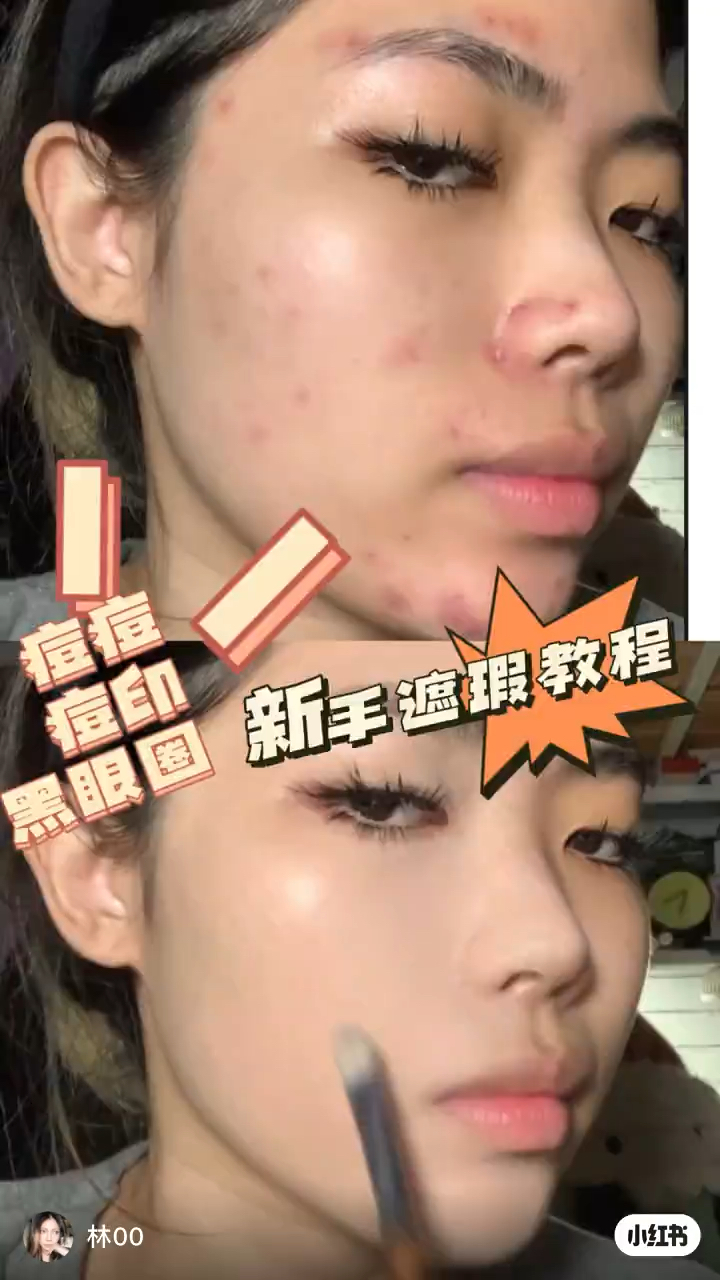 痘痘肌遮瑕我悟了❗️❗️满满的干货！！