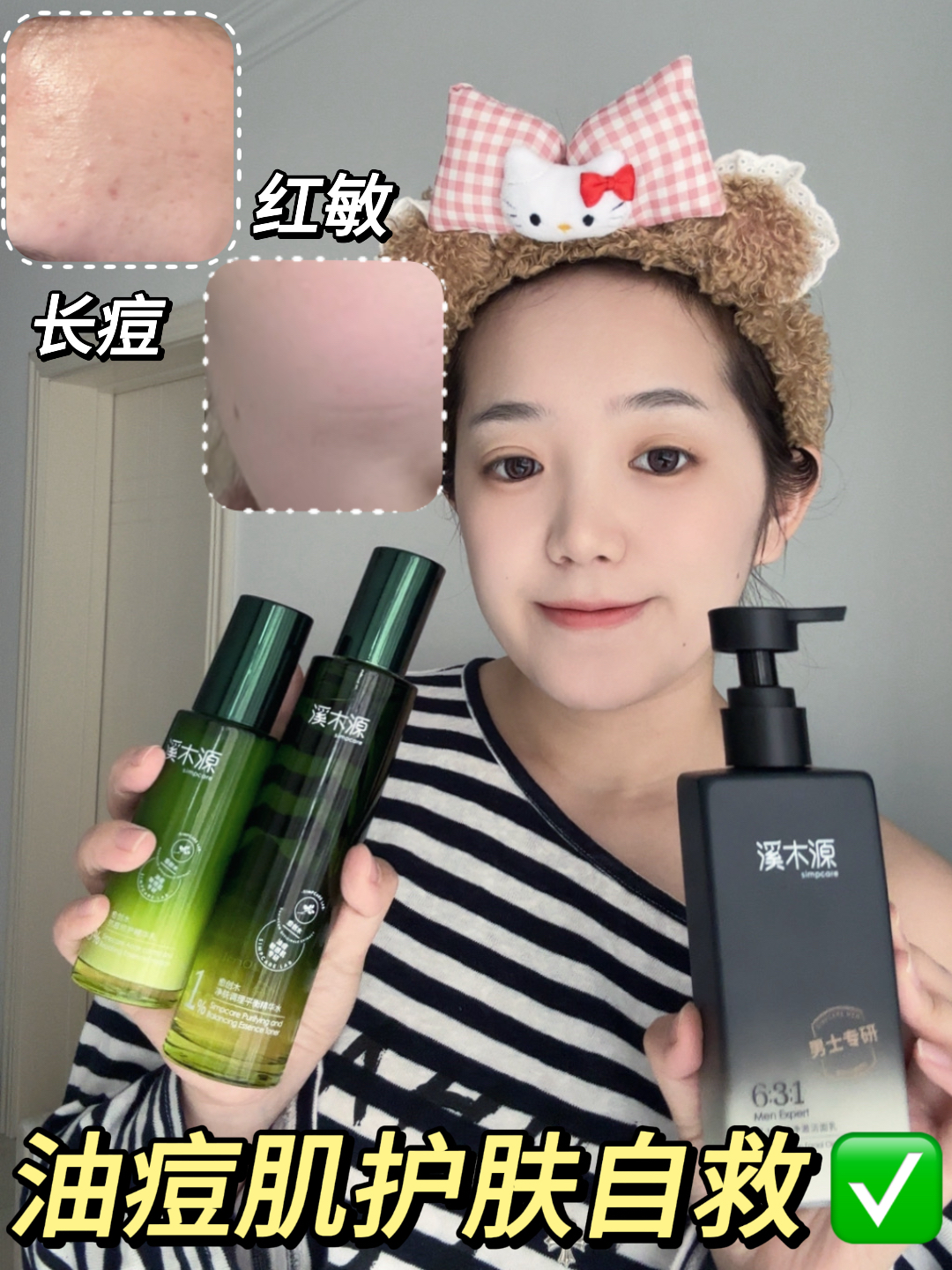 油痘肌坚持用这套！改造泛红长痘敏敏肌💘