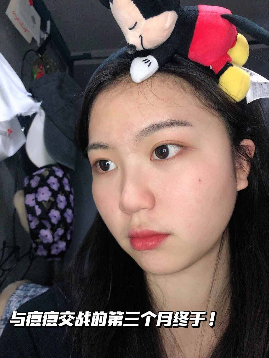 🎟想要温和祛痘？看看雅漾祛痘精华把！🎟