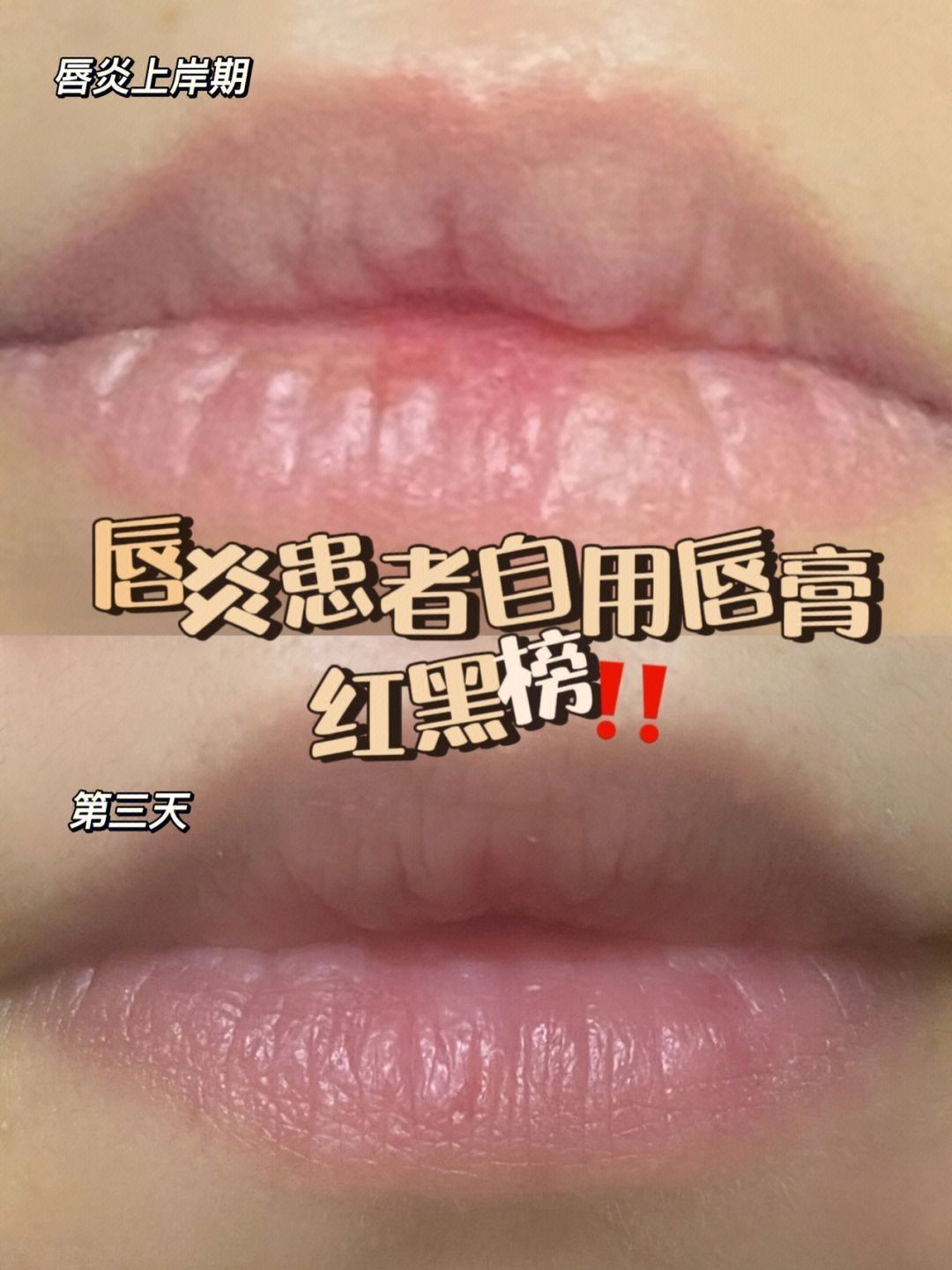 说了不要再撕嘴皮！来自唇炎患者唇膏测评‼️|||