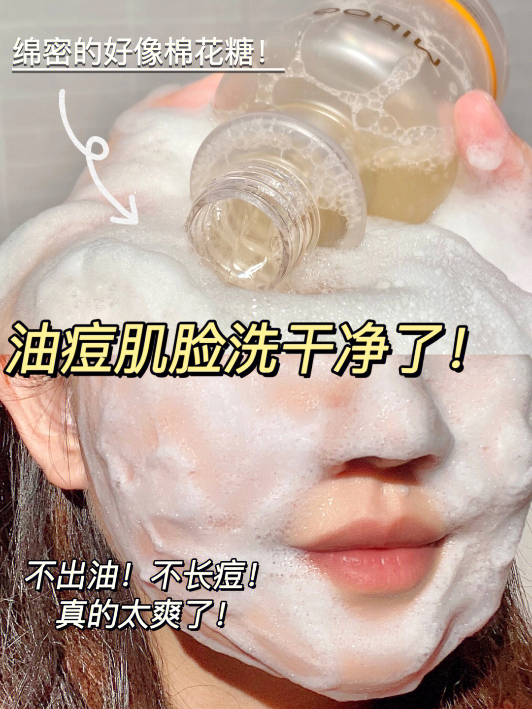油痘肌的脸终于洗干净了！黑头闭口达咩！
