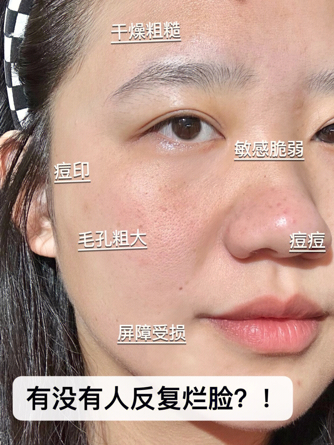 烂脸敏感肌用了医用敷料以后只想说！太妙了！