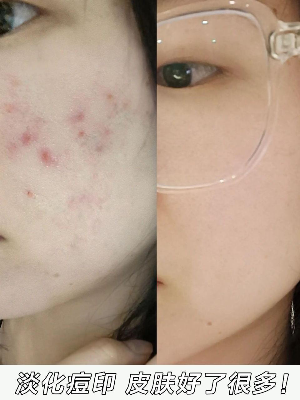 我天！这么去痘痘痘印真的有效果！