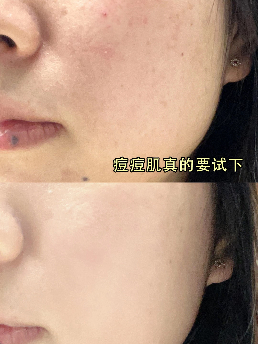 祛痘印精华真的卷啊‼小脸干净又清爽