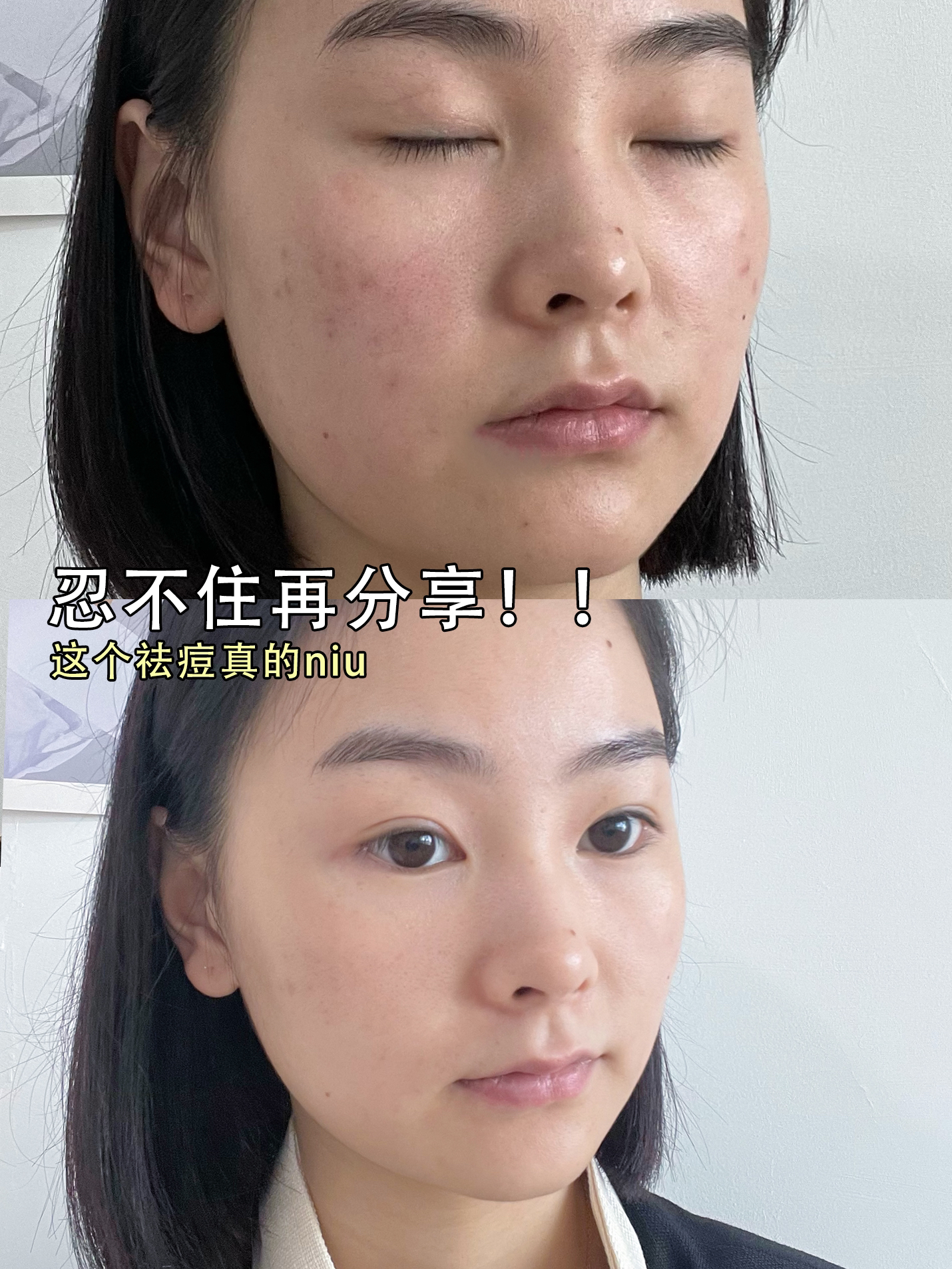 治痘神器，跟痘痘说拜拜