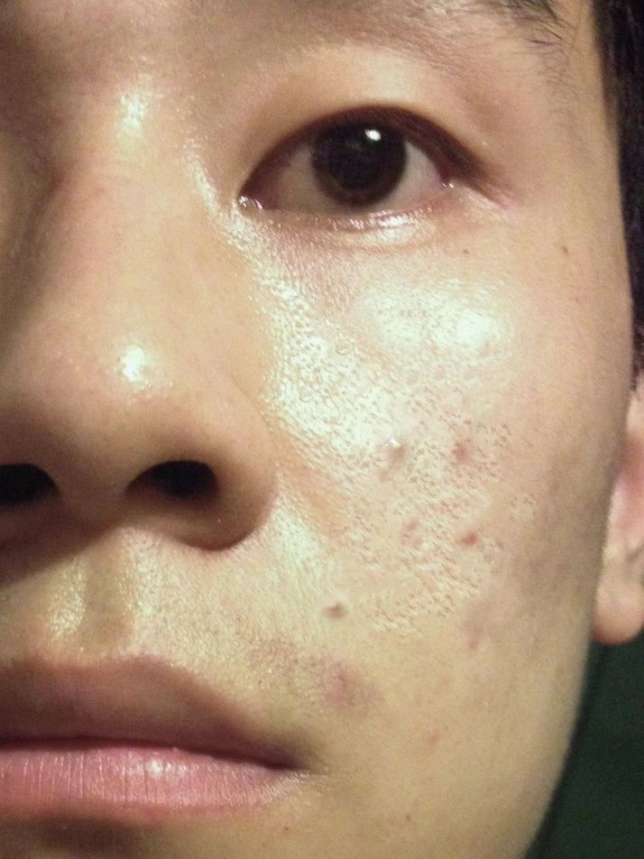 这居然是真的，油皮男生的痘痘就这样没了
