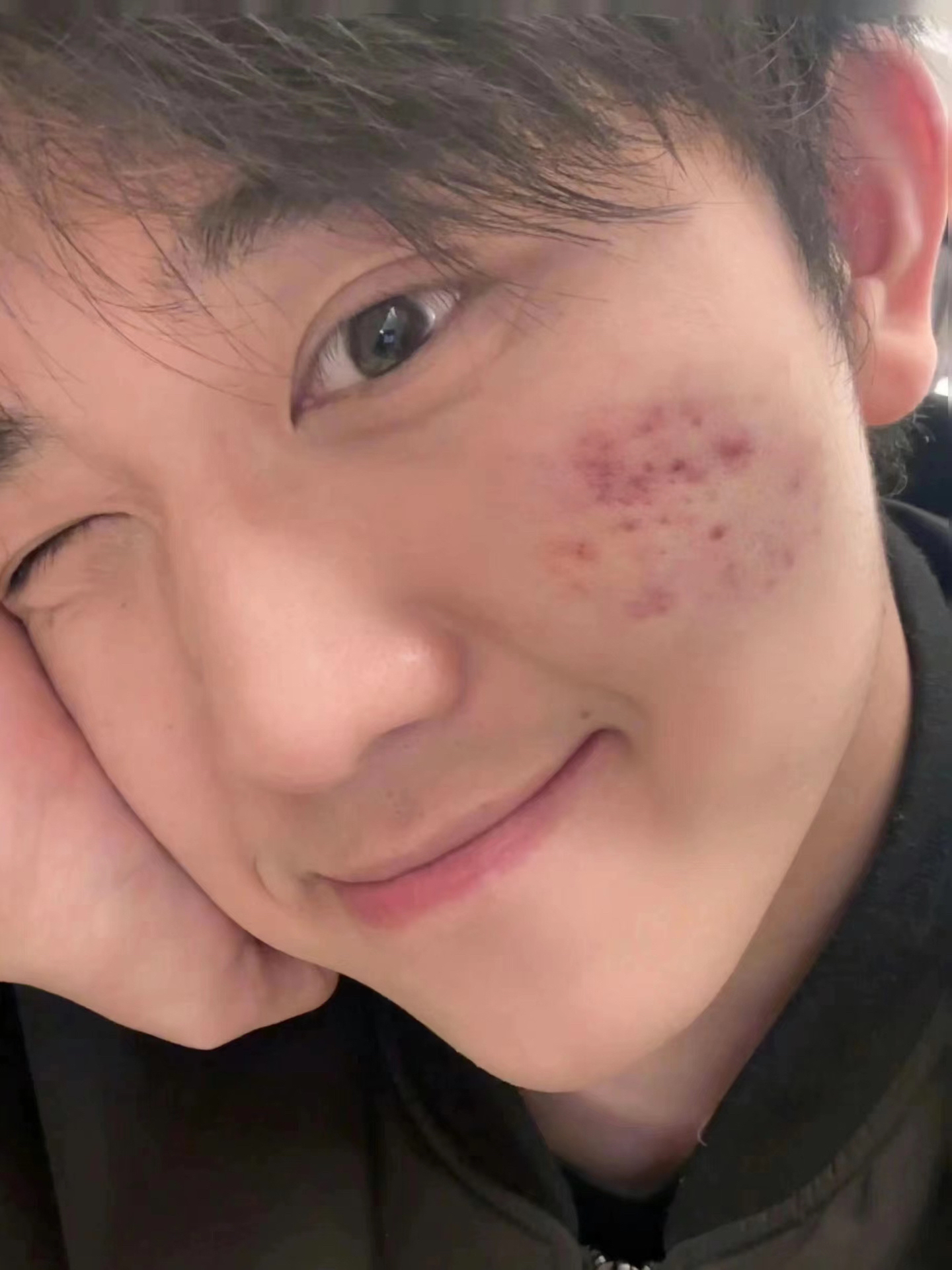 已上岸，痘痘已经消了七八成（油痘肌男