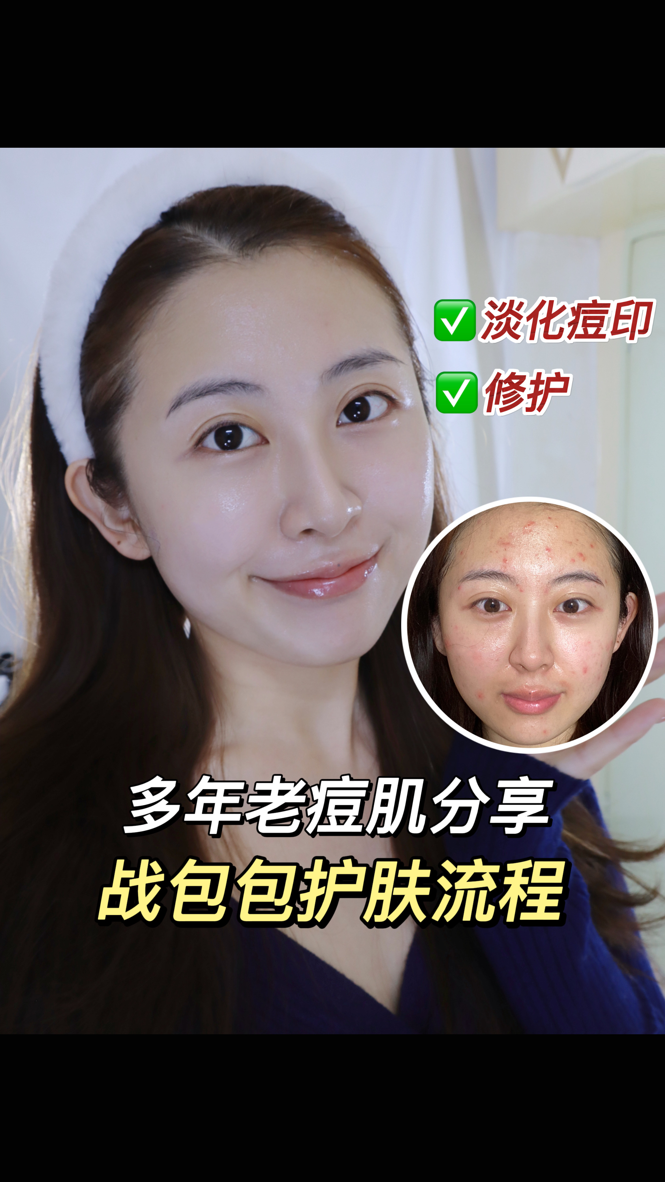 痘肌自救|告别反复长包包的困扰