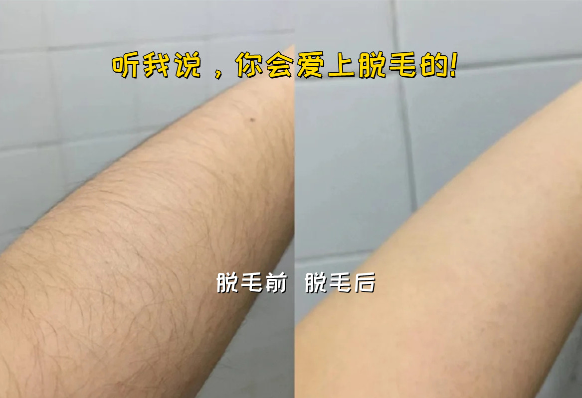 RNW|夏天无痛脱毛，助攻约会神器