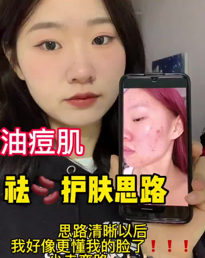 🫘油痘肌去痘心得|坚持精简护肤|拒绝焦虑❌