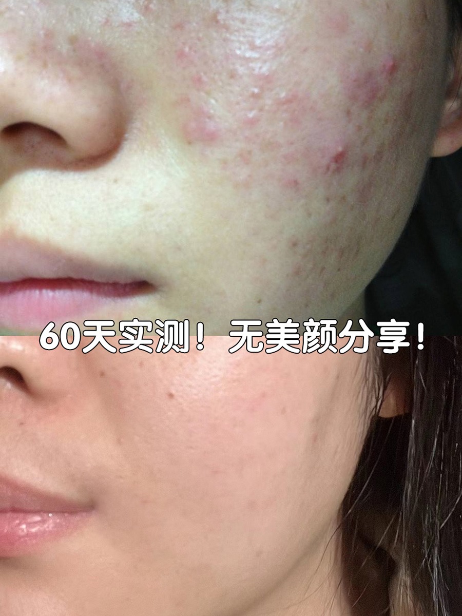吹爆的祛痘膏是真的好