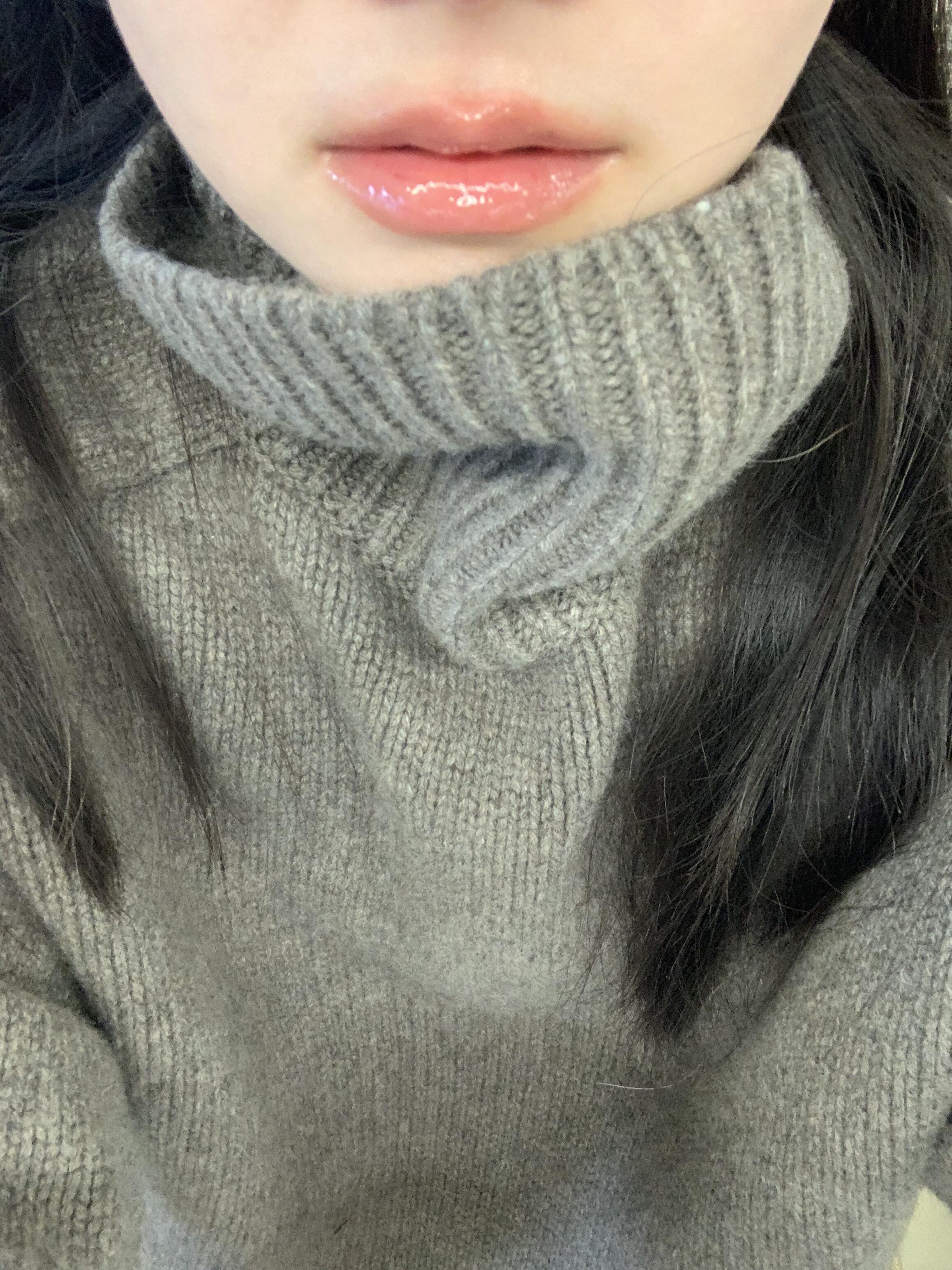 唇炎患者丨流水的润唇膏，铁打的凡士林