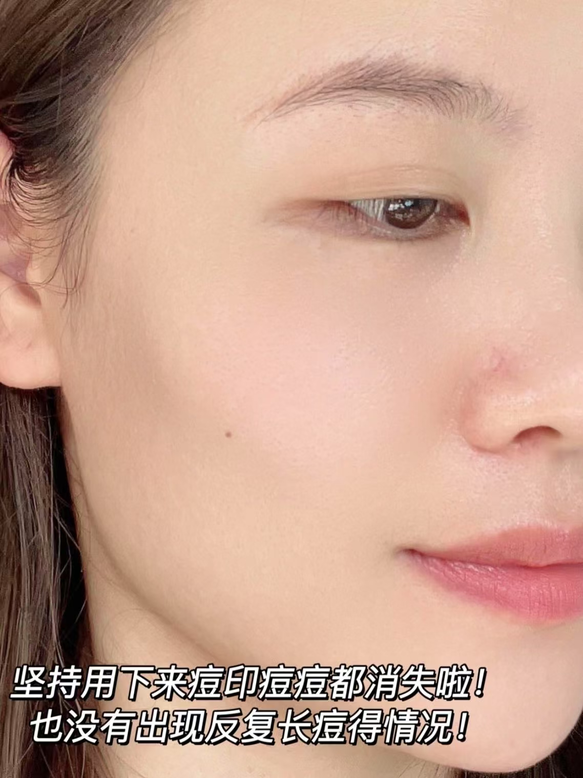 油痘肌狂喜！薇诺娜清痘精华太能打了💥